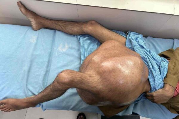 एम्स ऋषिकेशः सर्जरी से हटाया 35 किलो का बोन ट्यूमर, रचा इतिहास